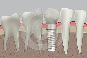 Vector normal teeth and dental implant.