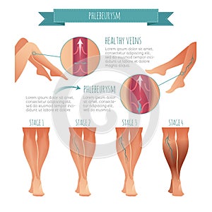 Vector Phlebology infographic. Stage of vein diseases