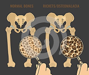 Vector Rickets Scheme