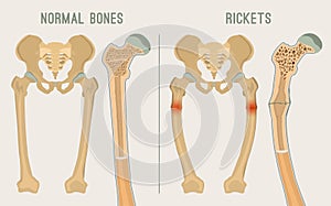 Vector Rickets Scheme