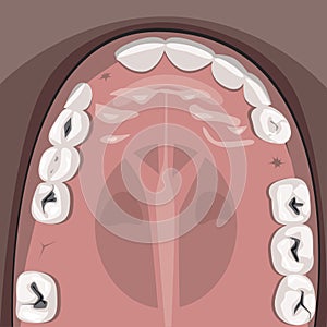 Karies kiefer aus ein Erwachsener Stühle Vor besuch zahnmedizinisch Klinik Vektor Lager illustrationen zähne 