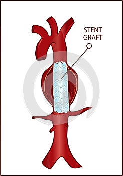 Vector - Thoracic descending aortic aneurysm and endovascular photo
