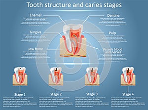 Vector tooth structure diagram and dental caries stages