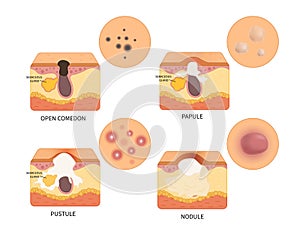 Vector types of acne photo