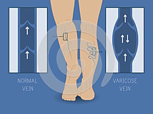 Vector varicose vein and normal vein. Slender and beautiful female legs.