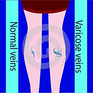 Vector varicose vein and normal vein. Slender and beautiful female legs. Varicose vein.