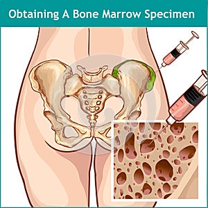 VECTOR Ä°LLUSTRATÄ°ON OF A BONE MARROW ASPIRATION