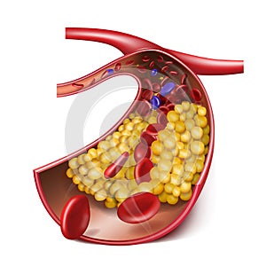 Vein with high cholesterol levels. Medical illustration