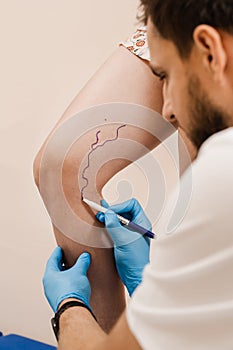 Vein markup. The phlebologist is marking legs before surgery to remove the veins. The vascular surgeon is marking leg