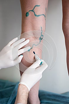 Vein markup. Vascular surgeon is marking veins for varicose surgery