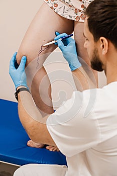 Vein markup. Vascular surgeon is marking veins for varicose surgery.