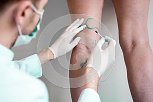 Vein markup. Vascular surgeon is marking veins for varicose surgery photo