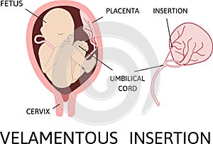 Velamentous insertion of umbilical cord. insertion site varies from the center