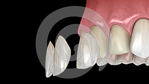 Veneer installation procedure over central incisor and lateral incisor