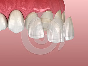 Veneer installation procedure over central incisor and lateral incisor. Medically accurate tooth illustration