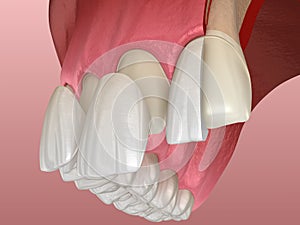 Veneer installation procedure over central incisor and lateral incisor. Sliced view, illustration