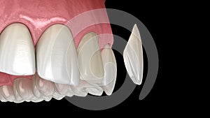 Veneer installation procedure over central incisor. Medically accurate tooth 3D illustration