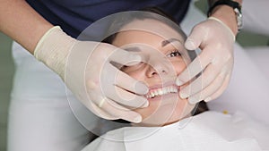 Veneers after fixation. Cosmetic dentistry veneers. Modern dental equipment and installation procedure of veneers in