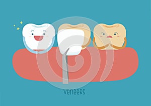 Veneers teeth of dental photo