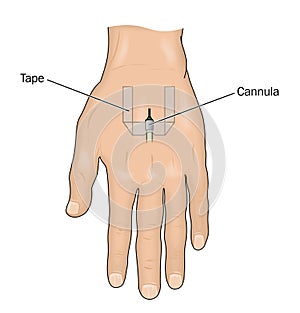 Venous cannula