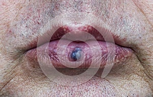 Venous lake of the lower lip of mouth. Healthcare and medical concept.