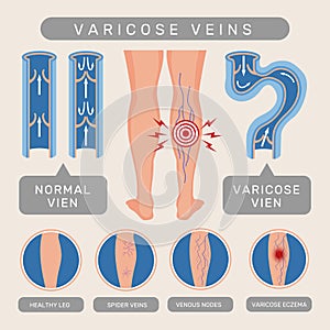 Venous problems. Infographic template of venous disease blood scheme systems varicose recent vector illustrations