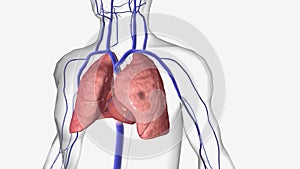 The Venous Thromboembolism Lung Damage