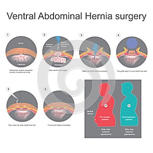 Ventral hernia is a bulge of tissues through an opening of weakness within your abdominal wall muscles. Info graphic vector.