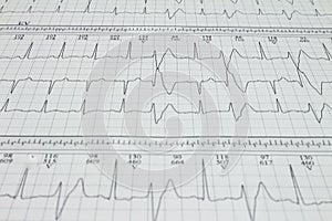 Ventricular extrasystole Bigeminism Cardiac arrhythmia recorded on an electrocardiogram