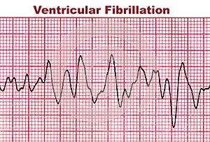 Ventricular Fibrillation - Deadly Heart Arrhythmia