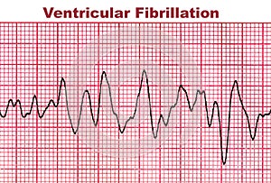 Ventricular Fibrillation - Deadly Heart Arrhythmia photo