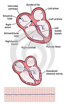 Ventricular fibrillation of heart