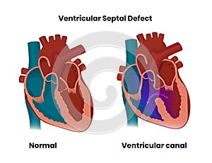 Ventricular septal defect with normal heart anatomy. Illustration of  the congenital heart defect