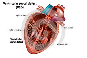 Ventricular septal defect VSD