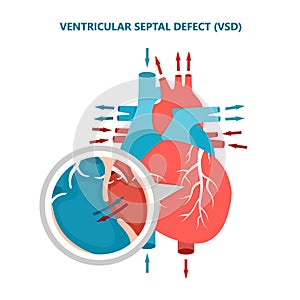 Ventricular septal defect VSD with heart blood flow. Human heart muscle diseases cross-section.