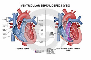 Ventricular Septal Defect (VSD)