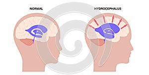 Ventricular system concept