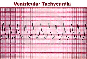 Ventricular Tachycardia - Deadly Heart Arrhythmia