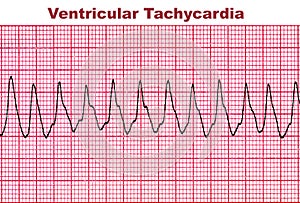 Ventricular Tachycardia - Deadly Heart Arrhythmia photo