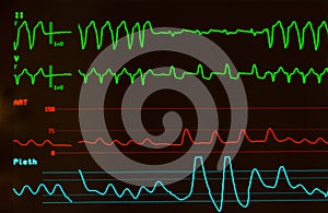 Ventricular Tachycardia on Monitor