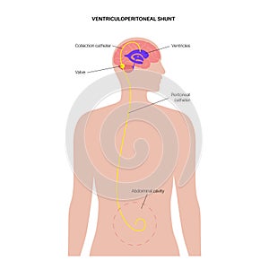 ventriculoperitoneal shunt concept