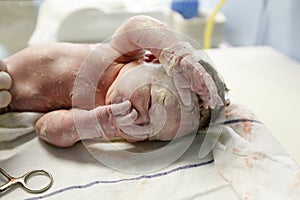 Vernix covered newborn after delivery