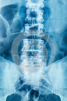 Vertebra Xray Showing the Lumber Spine