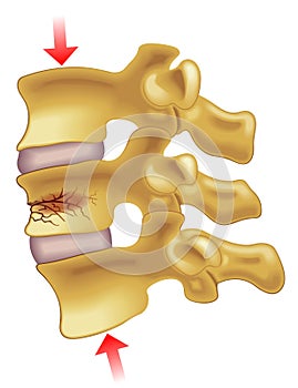 Vertebral compression fracture