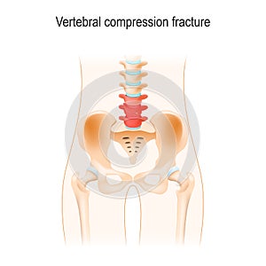 Vertebral compression fracture photo