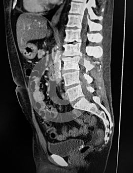 Vertebral degenerative joint disease with spondylosis, foraminal stenosis