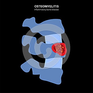 Vertebral osteomyelitis poster