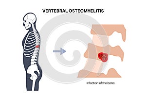 Vertebral osteomyelitis poster