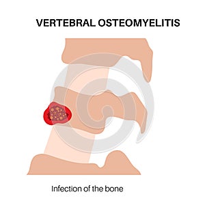 Vertebral osteomyelitis poster