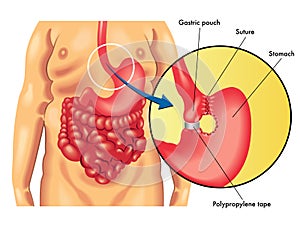 Vertical banded gastroplasty